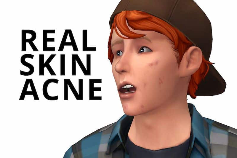 Acne Skin Detail CC