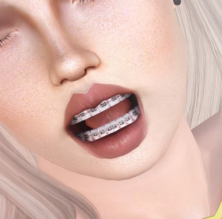 Teeth With Braces