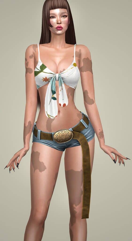 Vitiligo Eden Body-Face