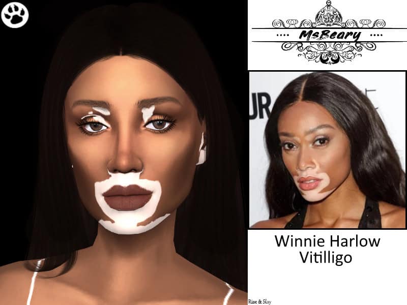 Winnie Harlow Vitiligo Skin Pattern