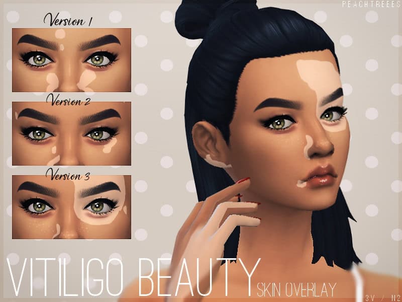 Vitiligo Beauty Skin Overlay N2