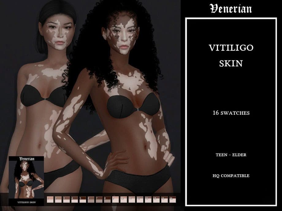 Vitiligo Skin – Female