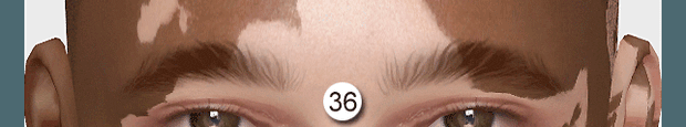 Marcus Vitiligo Eyebrows