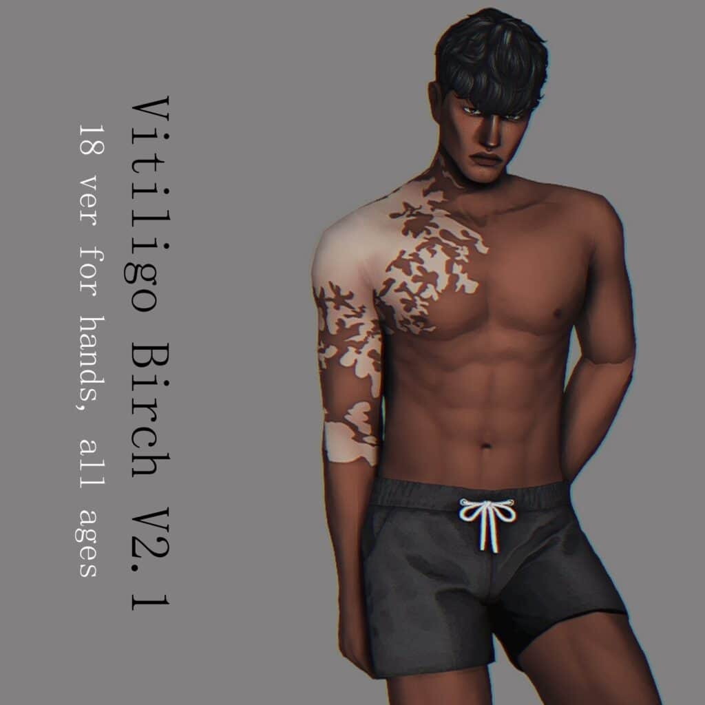 Vitiligo “Birch” Version 2.1