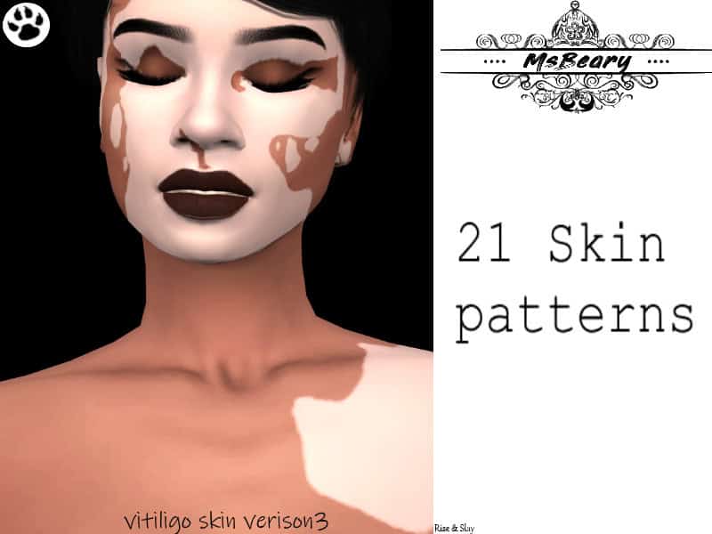 Vitiligo V3