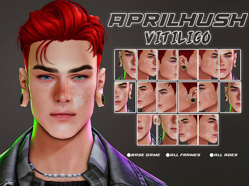 Vitiligo