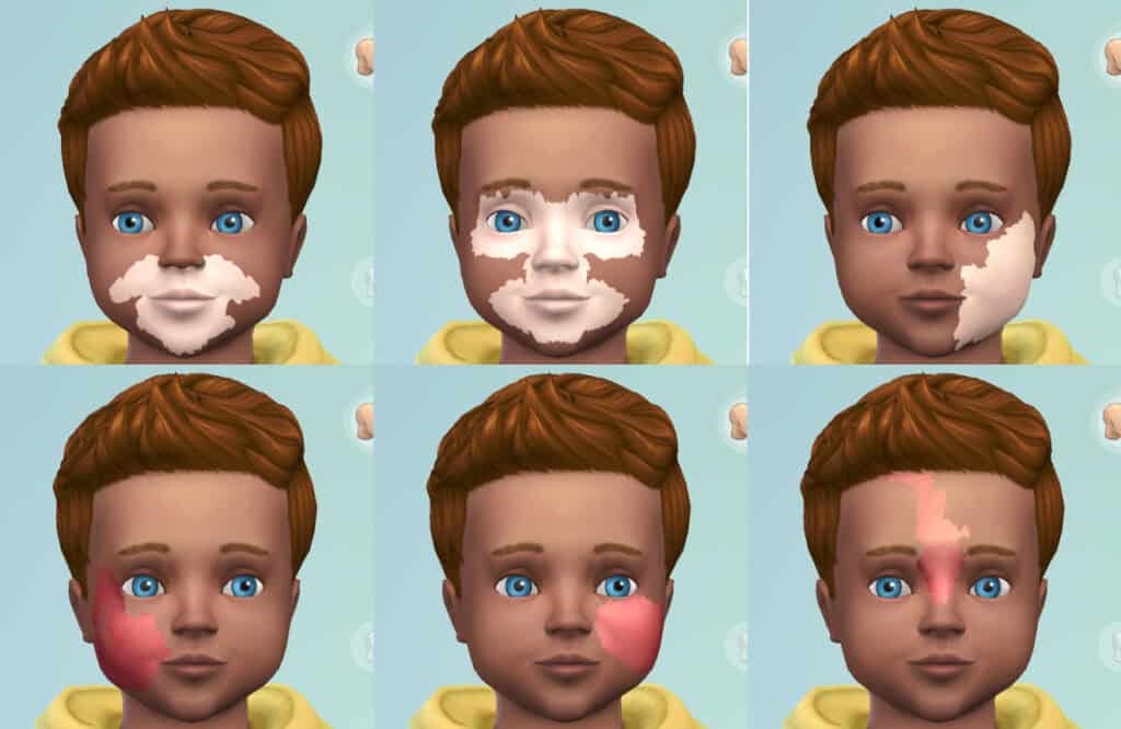 Vitiligo Facial Marks & Port Wine Stain for Toddlers