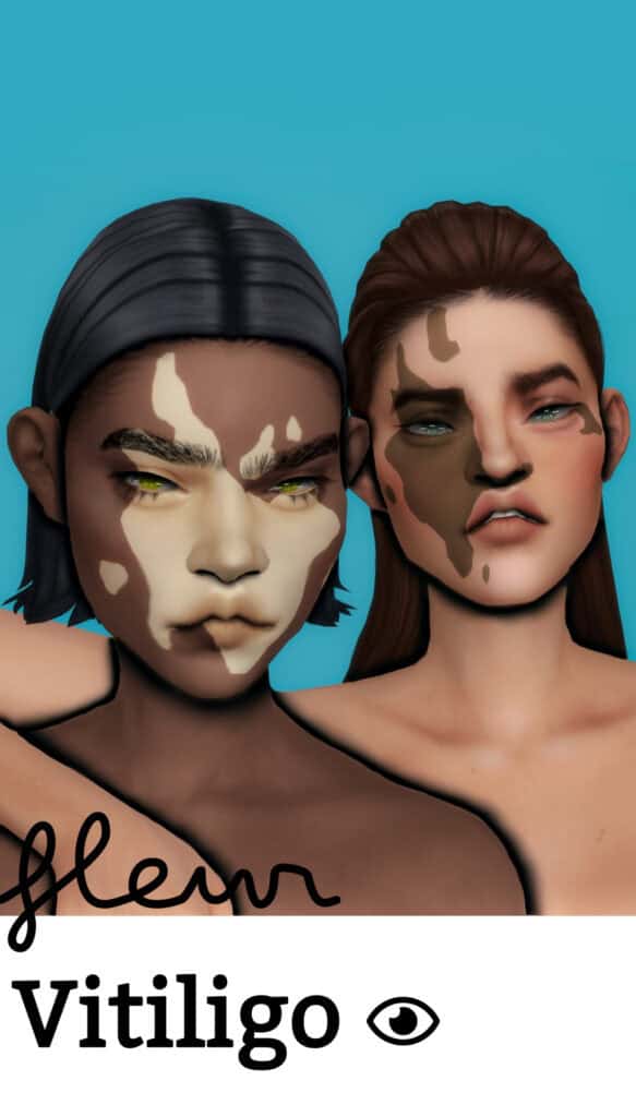 Fleur Vitiligo