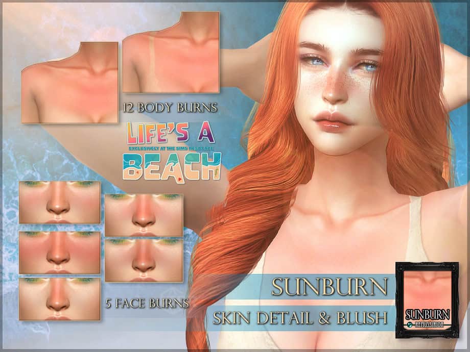 Life’s A Beach Sunburn Scar