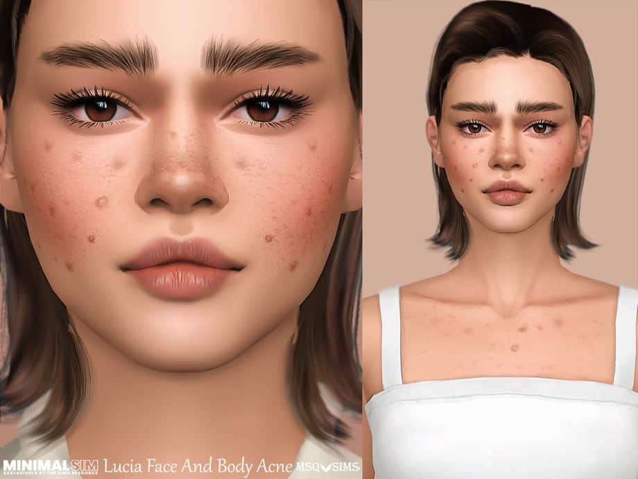 Lucia Face And Body Acne