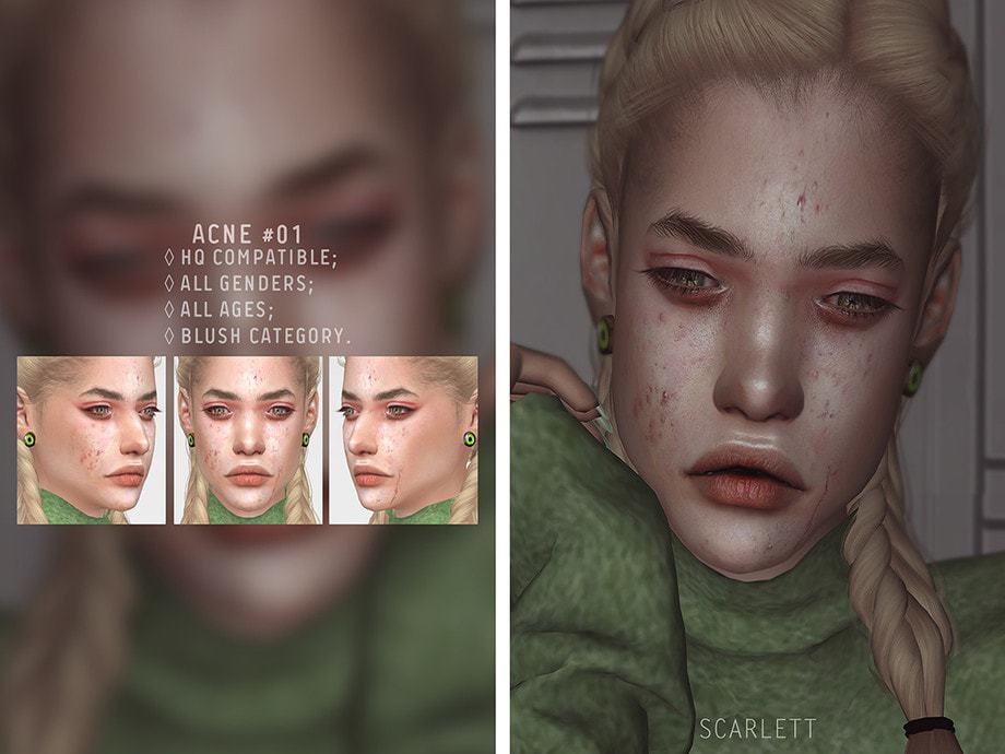 Acne #01
